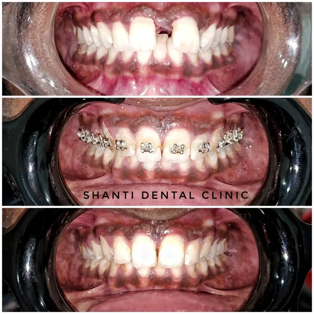 braces treatment before during after ahmedabad