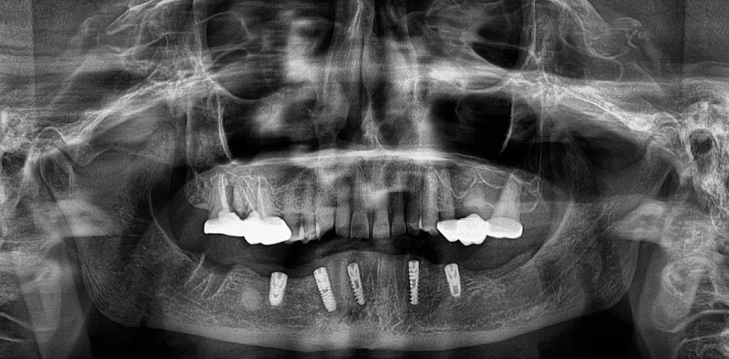 full arch implant rehabilitation opg xray