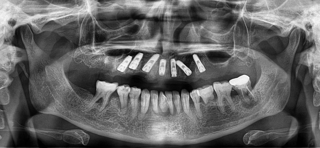 full mouth dental implants opg xray 2