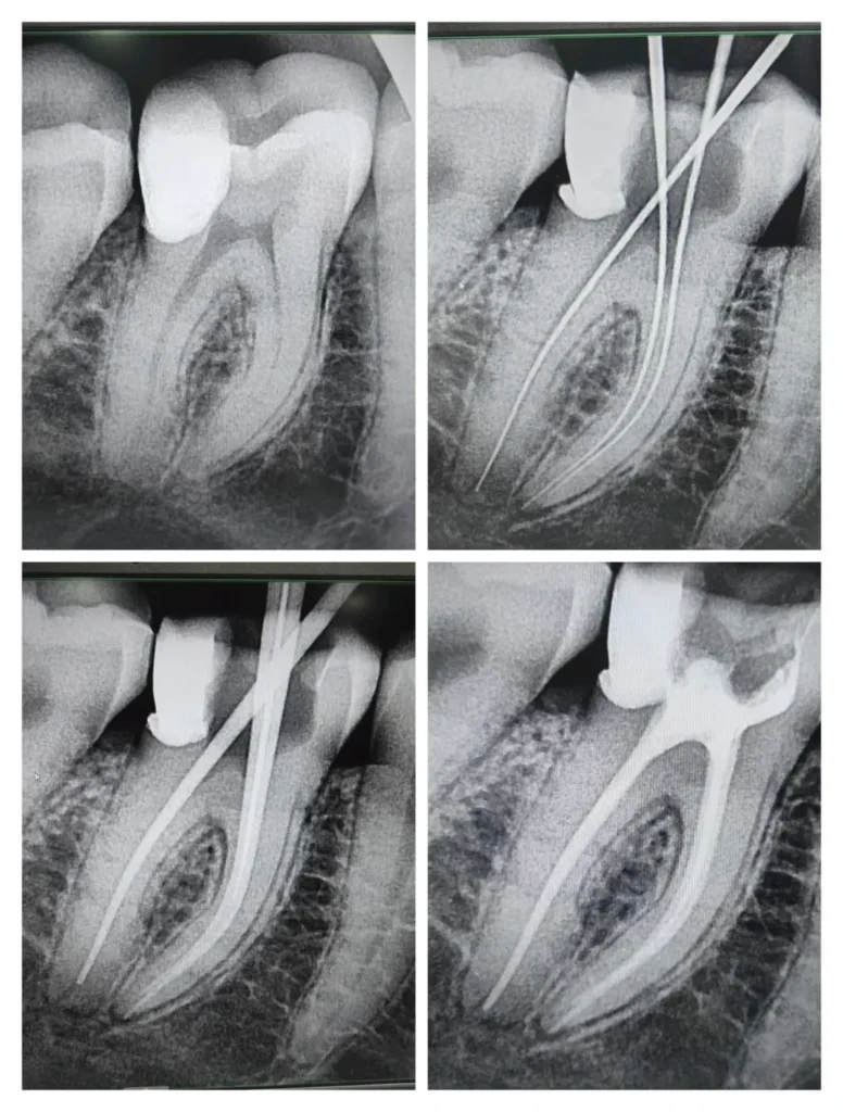 root canal treatment xray molar obturation