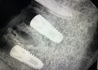 angled dental implants posterior jaw xray