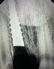 anterior dental implant front tooth xray