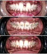 braces treatment before during after ahmedabad