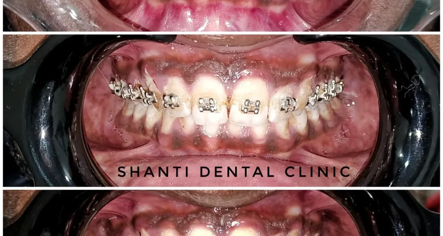 braces treatment before during after ahmedabad