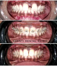 braces treatment before during after ahmedabad