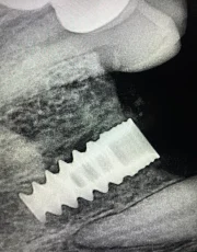 dental implant beside crowned tooth xray