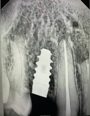 dental implant beside root canal treated tooth xray