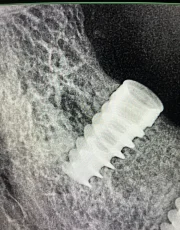dental implant in dense bone xray