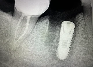 dental implant next to treated molar xray