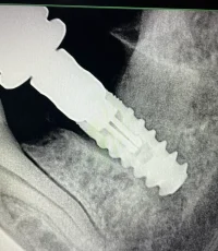 dental implant supporting bridge xray
