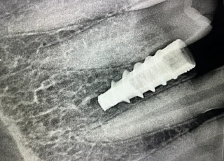 dental implant with healing abutment xray