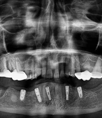 full arch implant rehabilitation opg xray