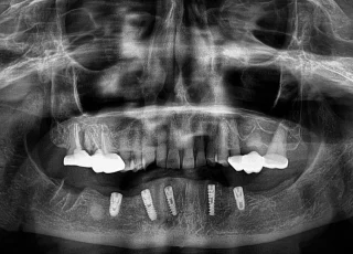 full arch implant rehabilitation opg xray
