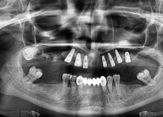 full mouth dental implants opg xray 1