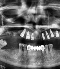 full mouth dental implants opg xray 1