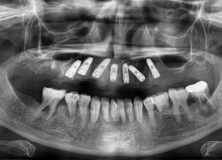 full mouth dental implants opg xray 2