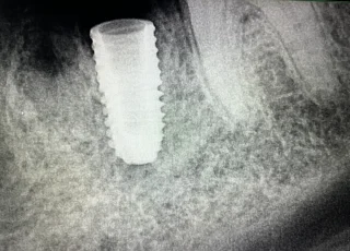 immediate dental implant placement xray