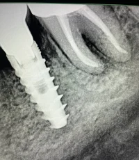 implant next to root canal filled molar xray
