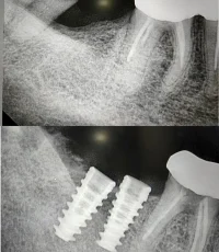 implant replacing failed root canal tooth xray