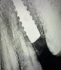 long dental implant upper jaw xray