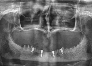 lower jaw dental implants opg xray