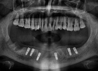 multiple dental implants opg xray lower jaw