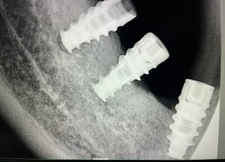 multiple dental implants posterior segment xray