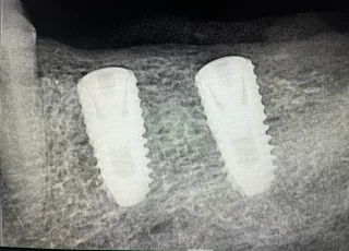 parallel dental implants lower jaw xray