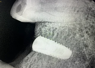 posterior dental implant bone support xray