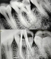 root canal treatment xray lower molar