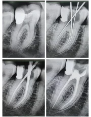 root canal treatment xray molar obturation