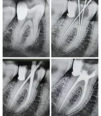 root canal treatment xray molar obturation