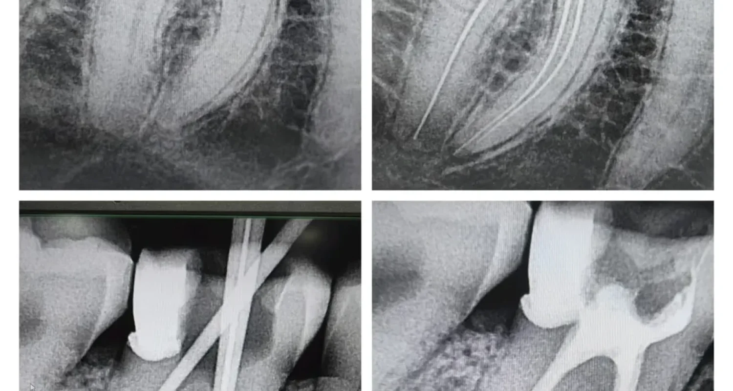root canal treatment xray molar obturation
