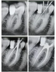 root canal treatment xray molar obturation