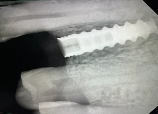 single dental implant with crown xray