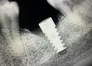single tooth dental implant lower jaw xray