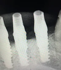 three dental implants full segment xray