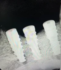 three dental implants lower arch xray