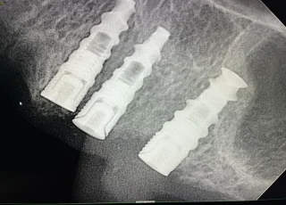 three dental implants rebuilding chewing side xray