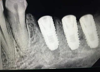 three dental implants replacing back teeth xray