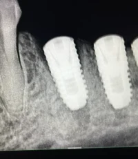 three dental implants replacing back teeth xray