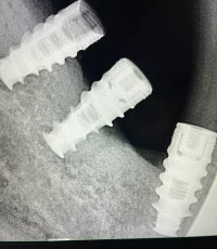 three dental implants staggered placement xray