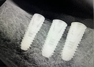 three dental implants upper jaw xray