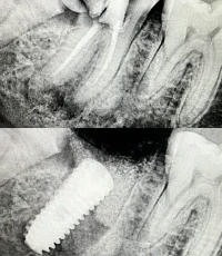 tooth extraction to dental implant xray