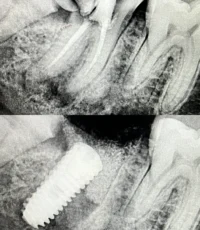 tooth extraction to dental implant xray