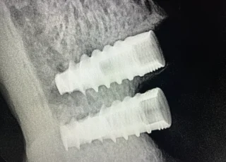 two dental implants behind natural tooth xray