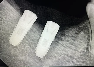 two dental implants different angulation xray