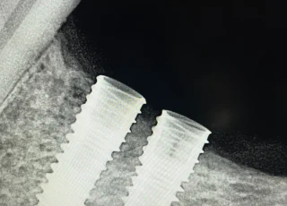 two dental implants lower back teeth xray