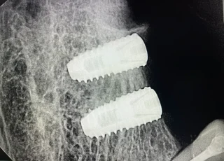 two dental implants molar premolar xray