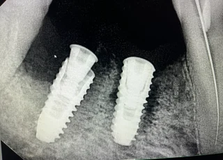 two dental implants molar region xray
